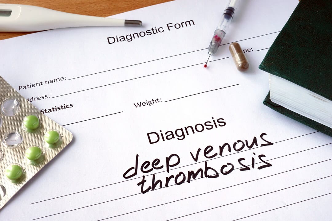 What Is Deep Vein Thrombosis (DVT)?